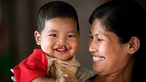 Организация Operation Smile Vietnam в июне сделала  хирургические операции   более 60 детям с врожденными дефектами